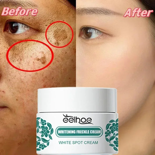 eelhoe Niacinamide Melasma Brightening Cream Reduce Melanin Brighten Cream Lighten Dark Skin Chloasma Serum Fade Fine Face Lines